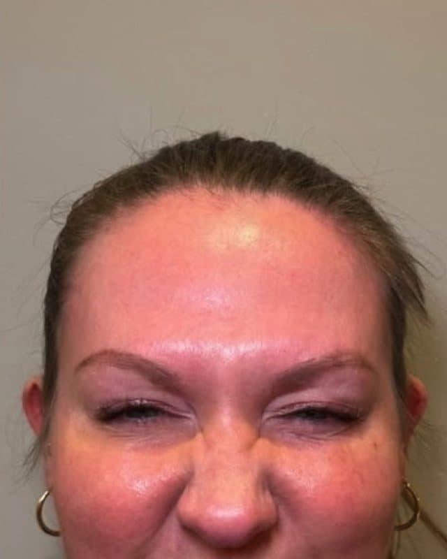 After: Botox, frown lines and lines across the nose