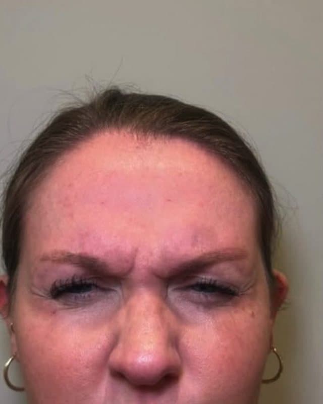 Before: Botox, frown lines and lines across the nose