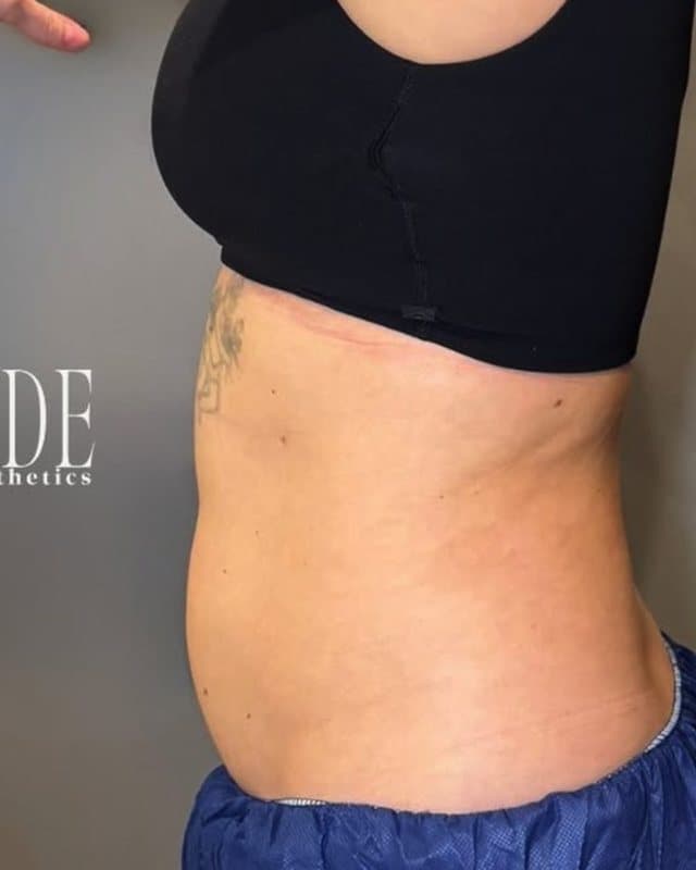 After: CoolSculpting, flank, side view of the flank and lower back