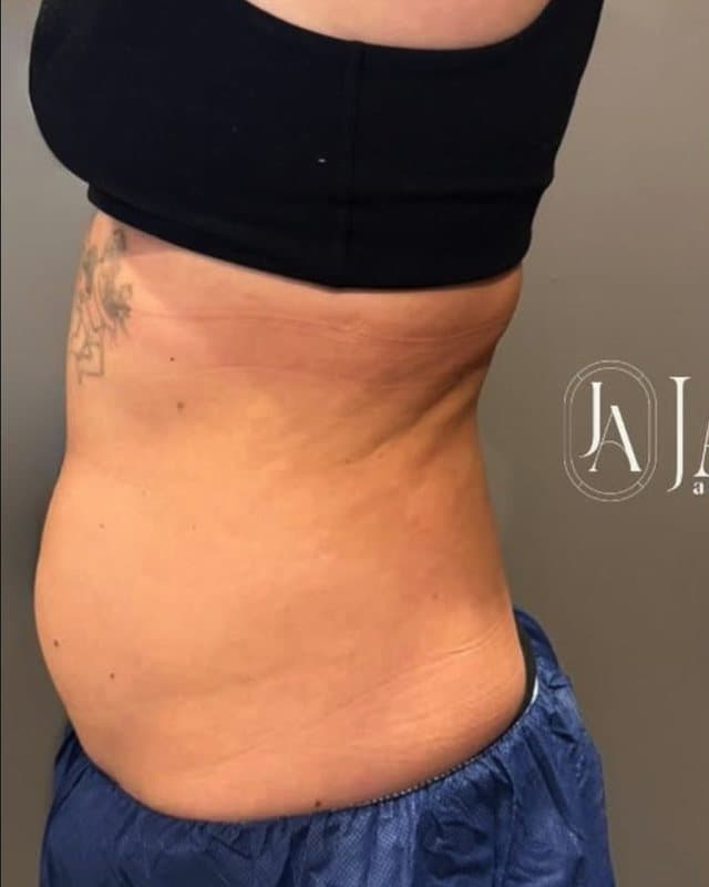 Before: CoolSculpting, flank, side view of the flank and lower back