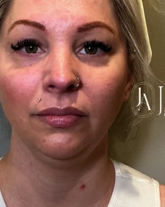 Before: CoolSculpting, jawline, front view of the jawline and chin