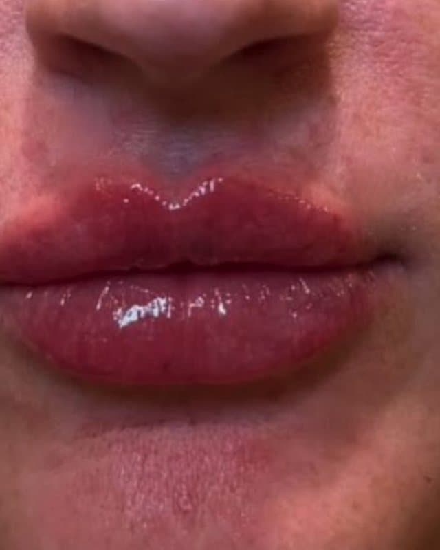 After: Lip filler, close-up of the lips