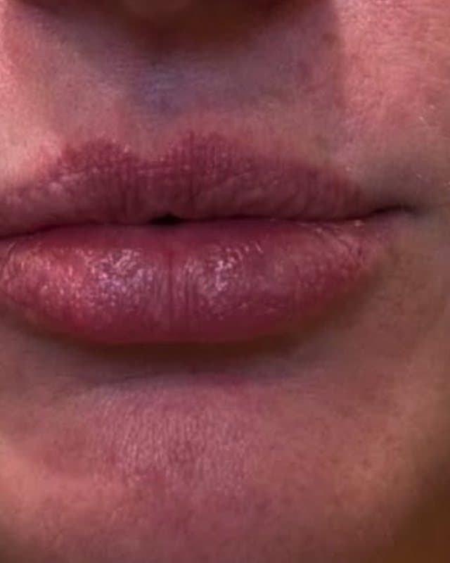 Before: Lip filler, close-up of the lips