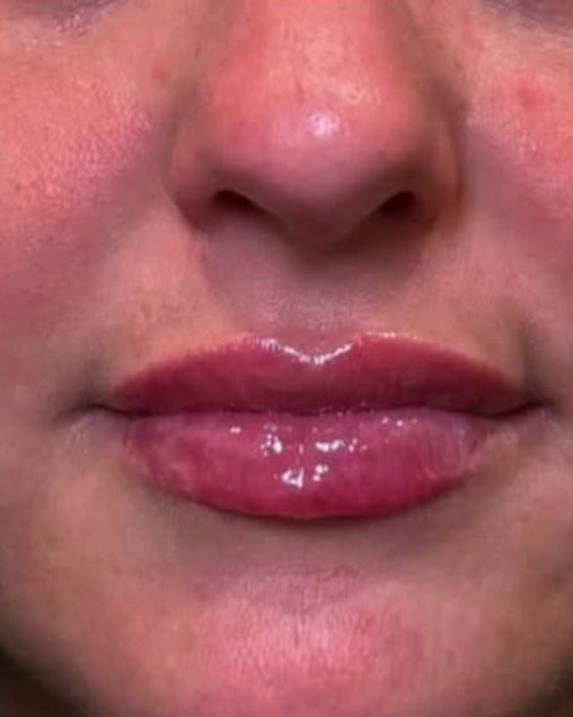 After: Lip filler, front view of the lips