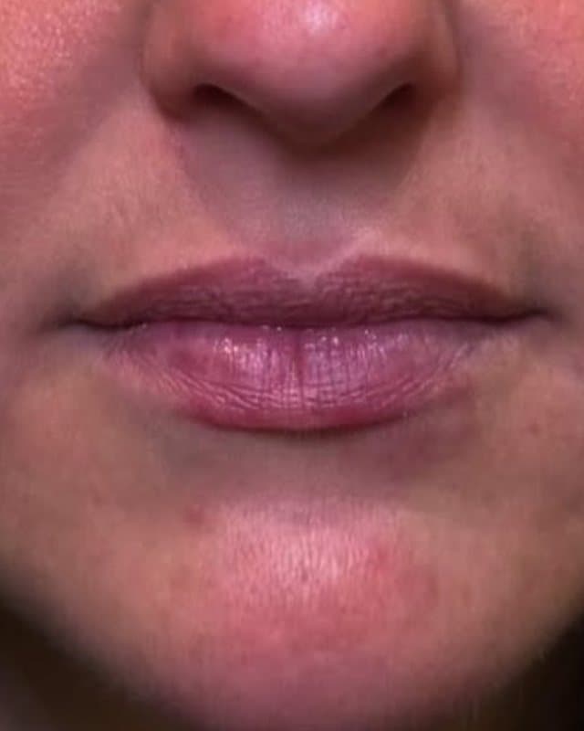 Before: Lip filler, front view of the lips