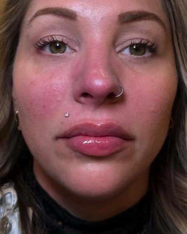 After: Lip filler, full-face front view