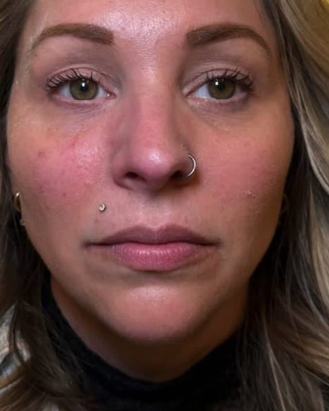 Before: Lip filler, full-face front view