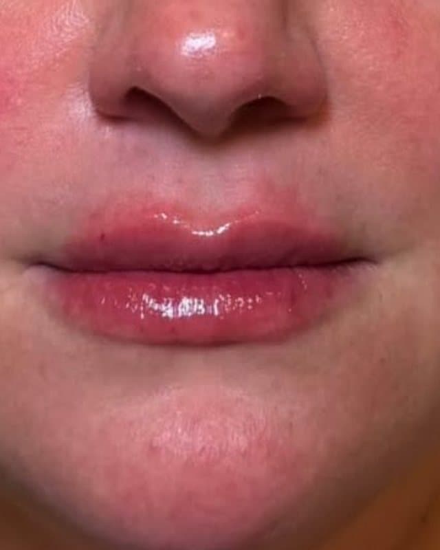 After: Lip filler, front view of the upper and lower lips