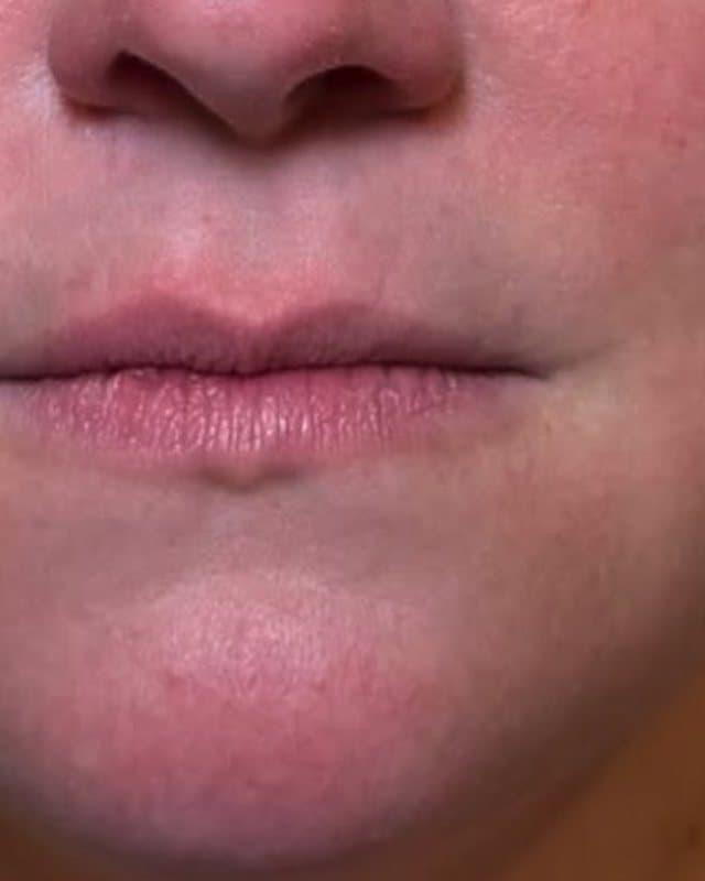Before: Lip filler, front view of the upper and lower lips