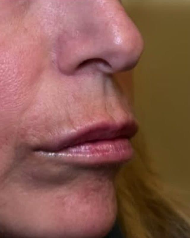 After: Lip filler, side view of the lips