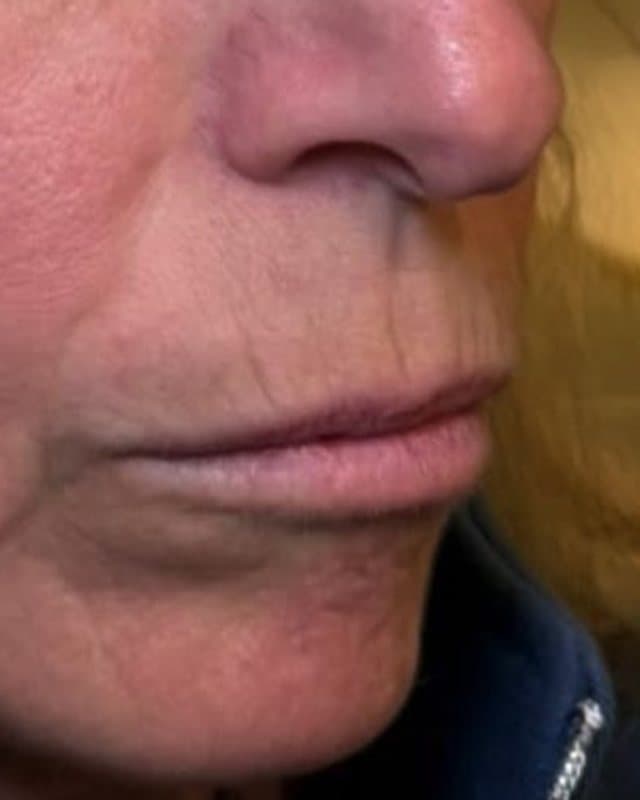 Before: Lip filler, side view of the lips