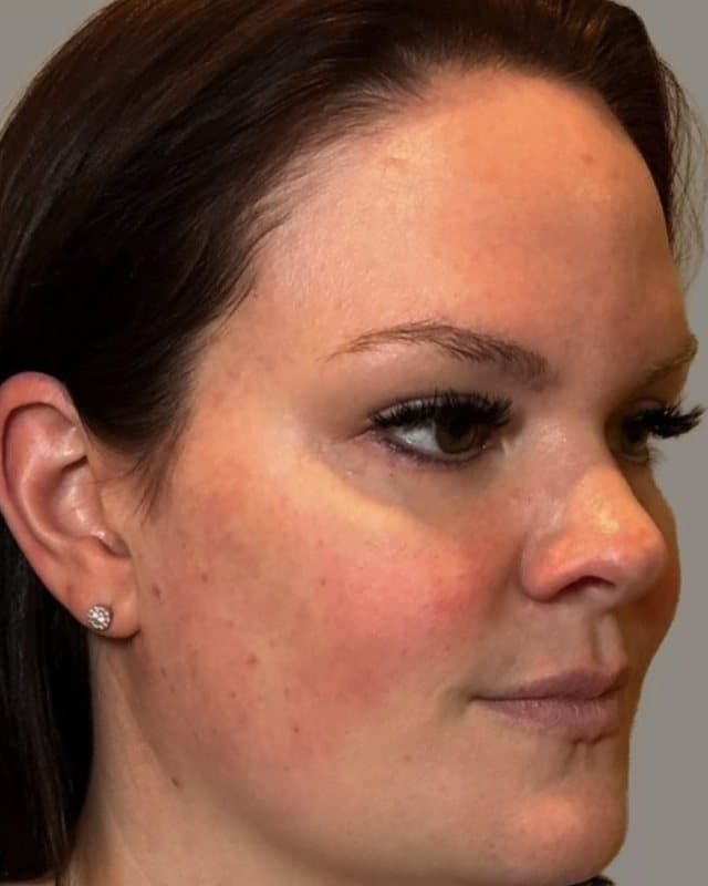 After sylfirm x + sculptra, three-quarter view of the face