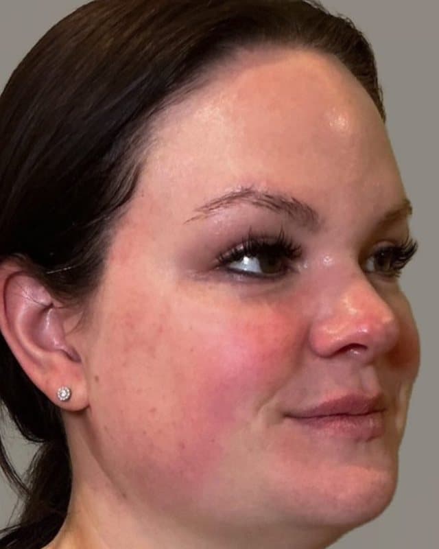 Before sylfirm x + sculptra, three-quarter view of the face