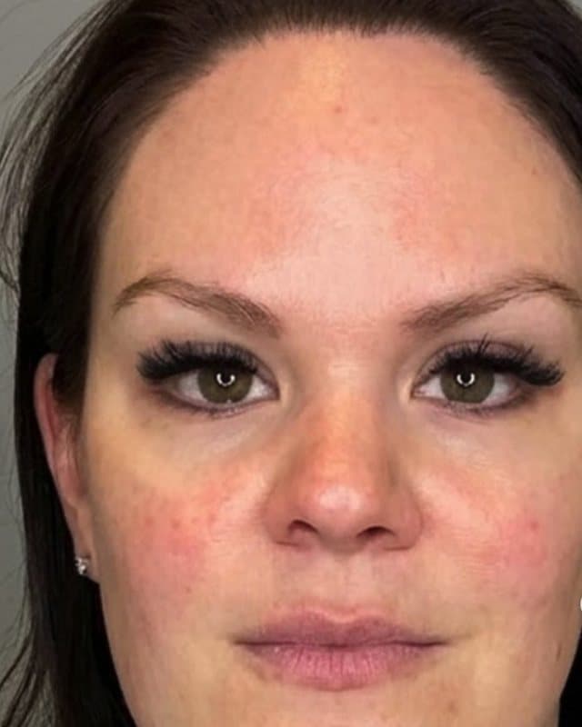 After sylfirm x + sculptra, front view of the face