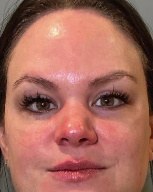 Before sylfirm x + sculptra, front view of the face